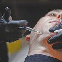 Injecté sous forme de gel, l’acide hyaluronique repulpe les lèvres, sculpte les pommettes ou lisse les rides.