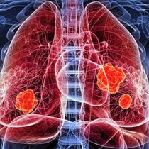 8000, c’est le nombre de patients dans le monde atteints chaque année d’un mélanome uvéal. Il s’agit du type de cancer de l’œil le plus fréquent chez l’adulte.