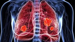8000, c’est le nombre de patients dans le monde atteints chaque année d’un mélanome uvéal. Il s’agit du type de cancer de l’œil le plus fréquent chez l’adulte.
